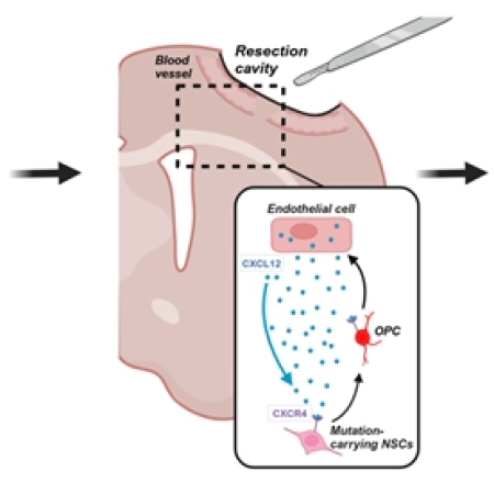 Distant origin of glioblastoma recurrence: neural stem cells in the subventricular zone serve as a source of tumor reconstruction after primary resection